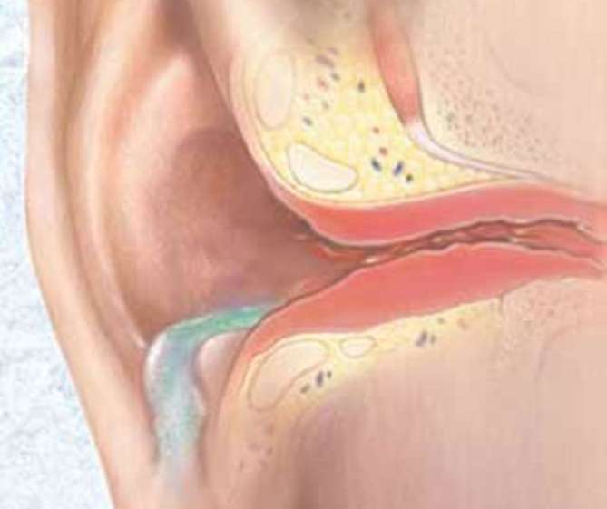 Как лечить отит среднего уха в домашних условиях?