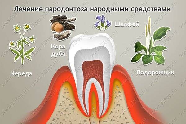 Как лечить парадонтоз: какие лекарства и народные средства помогают, как спасти зубы и советы стоматологов