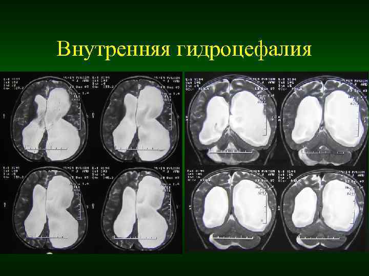 Наружная заместительная гидроцефалия головного мозга: причины, симптомы, лечение и прогноз