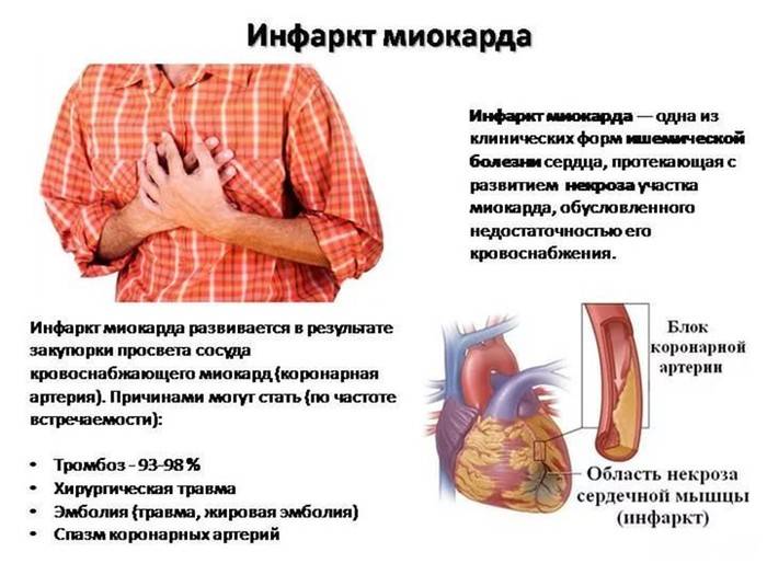 Инфаркт миокарда: симптомы, лечение, первая помощь | азбука здоровья