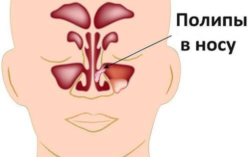 Сухая заложенность носа: сухость и закладывает уши без насморка, лечение