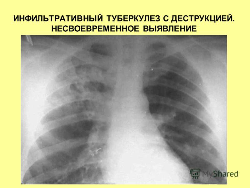 Почему развивается очаговый туберкулез легких?