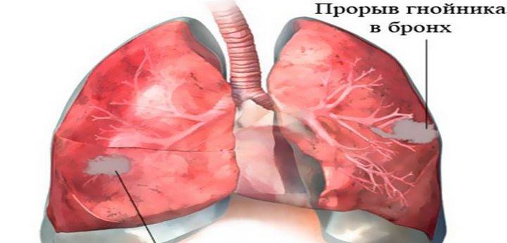 Пневмония лёгкой, средней и тяжёлой формы: последствия