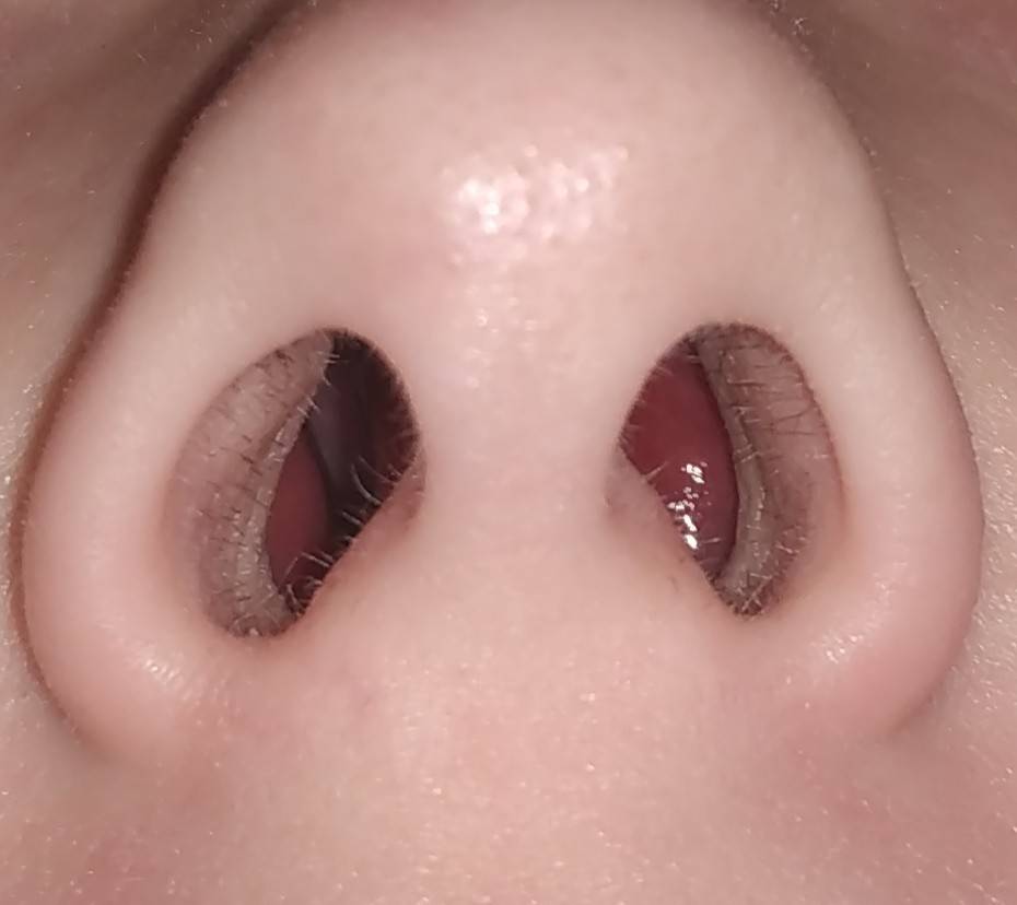 Симптомы и лечение полипов в носу у ребенка