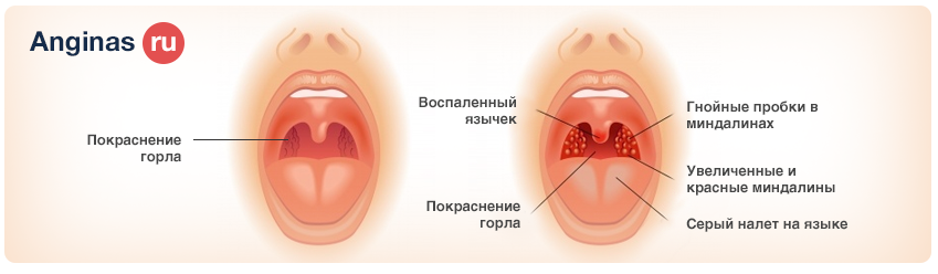 Вирусная или бактериальная ангина, отличия, как распознать и лечить