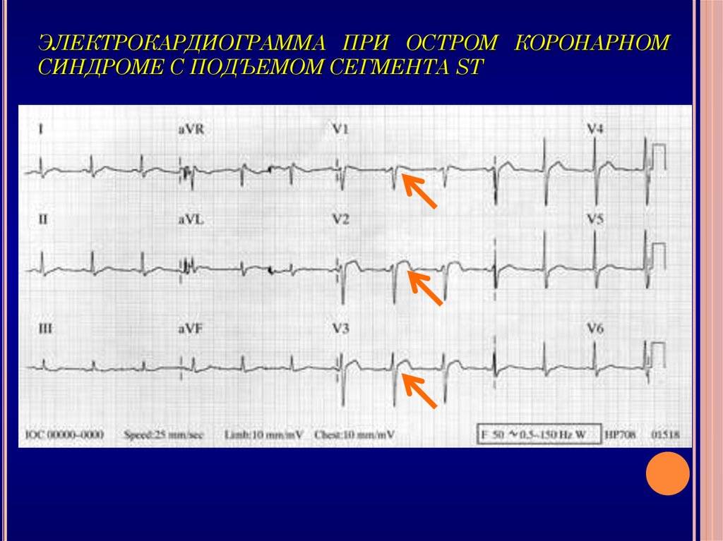 Острый инфаркт миокарда с подъемом сегмента st электрокардиограммы