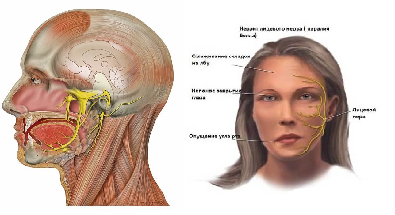 Воспаление лицевого нерва (невралгия, невропатия или парез): симптомы и лечение