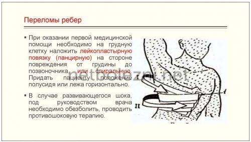 Сколько заживает перелом ребер, как долго болит | perelomkocti.ru