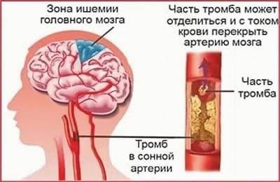 Атеросклероз сосудов головного мозга – симптомы и лечение