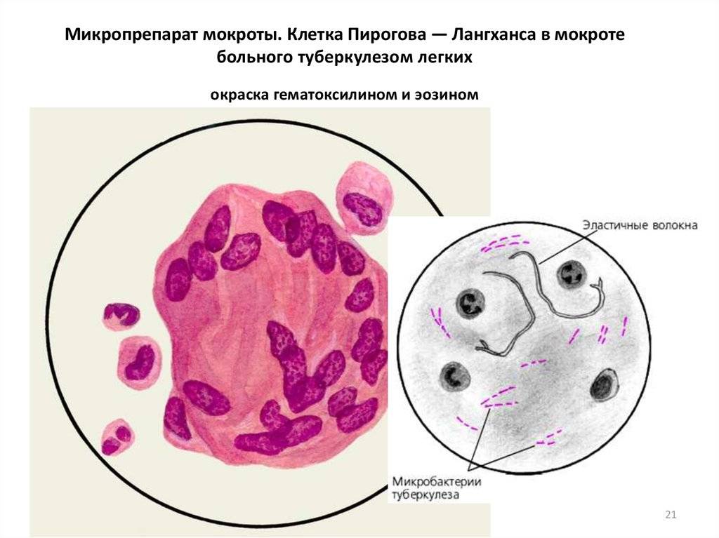Мокрота при онкологии легких: какого цвета, какой характер, коричневые выделения