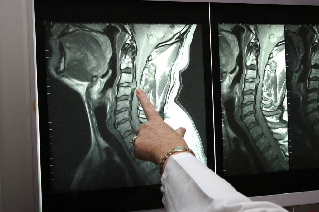 Рентген шеи нестабильность шейного отдела позвоночника