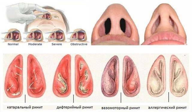 Причины и лечение сухости в носу — что делать и чем увлажнить слизистую носа?