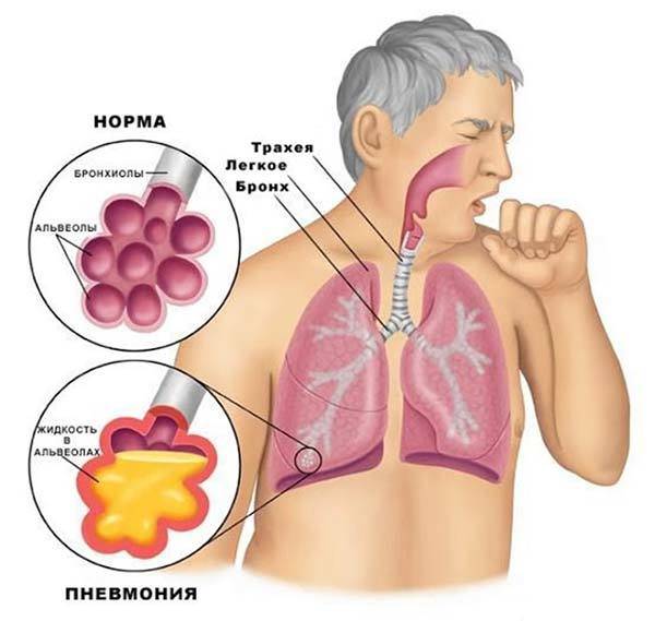 Как распознать пневмонию у взрослых в домашних условиях - как определить воспаление легких дома, как понять и выявить, как диагностировать