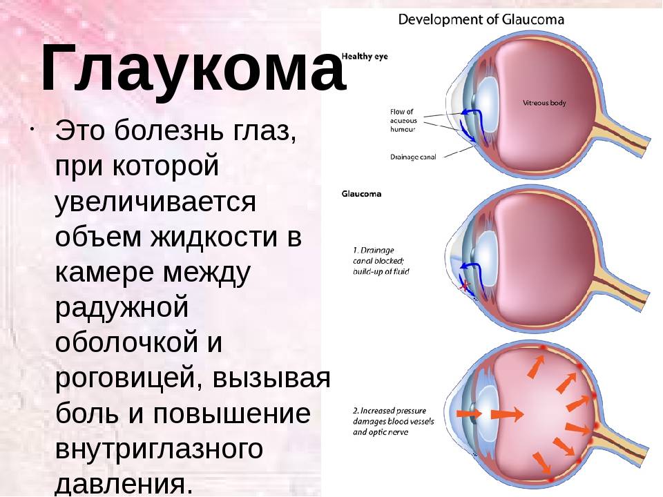 Глаукома: лечение народными средствами
