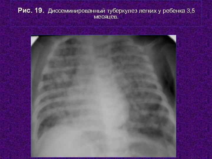 Очаговый туберкулез легких: причины, симптомы и лечение
