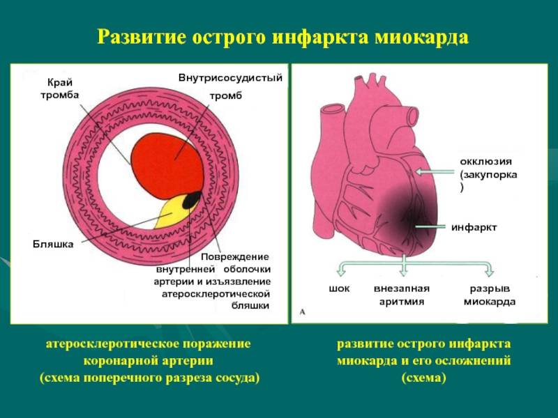 Связь инфаркта миокарда и стенокардии, причины развития и методы лечения патологий