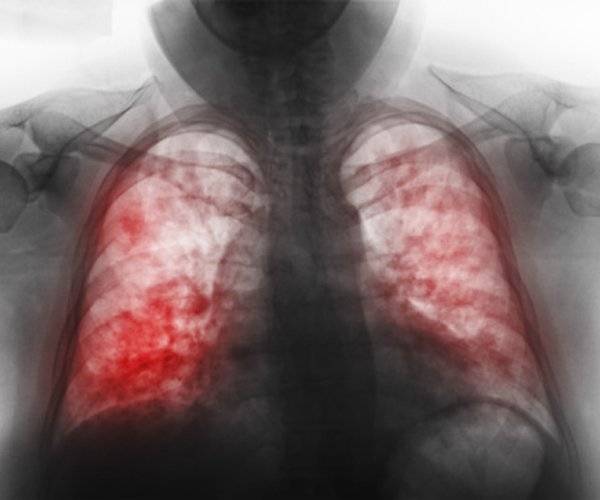 Что такое пневмония?
