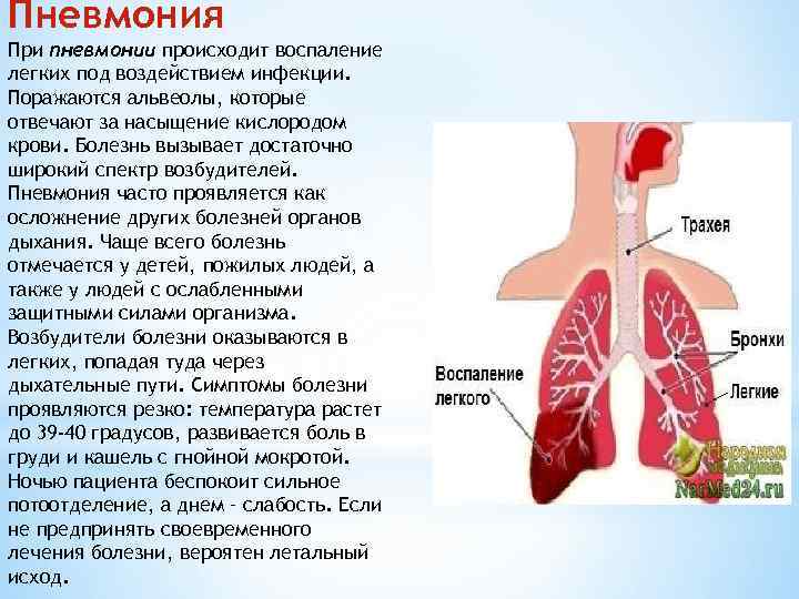 Пневмонит: отличие от пневмонии, причины, симптомы, принципы лечения