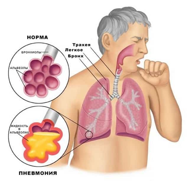 «пневмония при covid-19 похожа на пневмонии при свином гриппе». интервью с пульмонологом