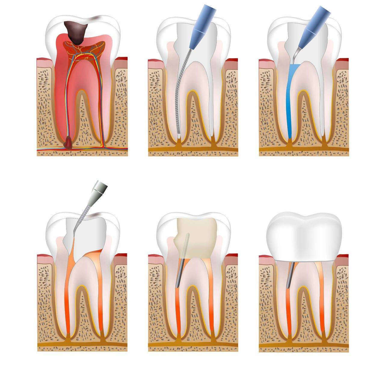 Последняя стадия поражения зуба: этапы лечения глубокого кариеса