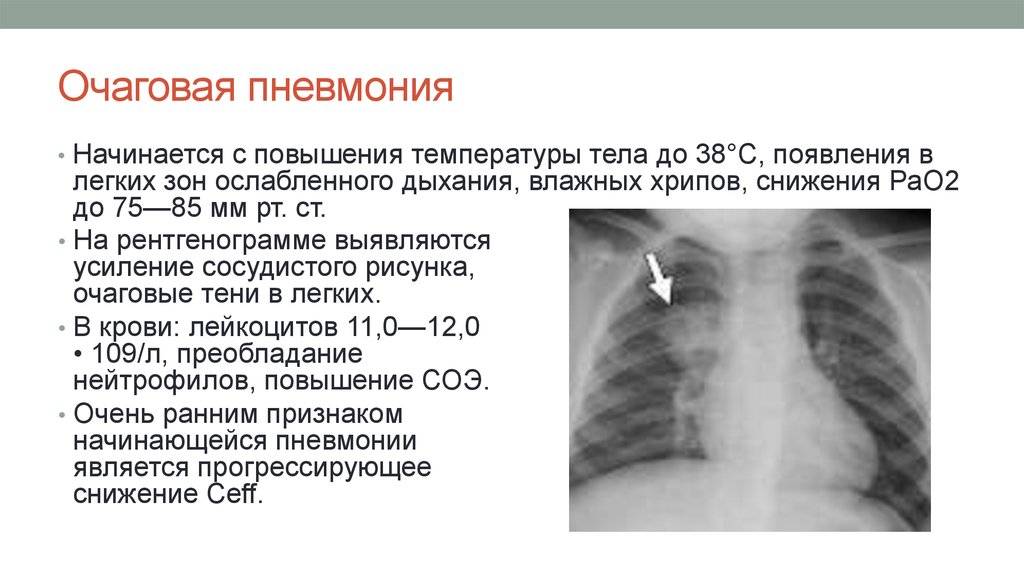 Двухсторонняя пневмония: симптомы и лечение | pnevmonya.ru