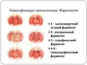 Заразен ли фарингит для окружающих и как он передается pulmono.ru
заразен ли фарингит для окружающих и как он передается