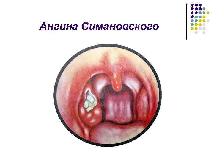 Язвенно-некротическая ангина венсана симановского – лечение