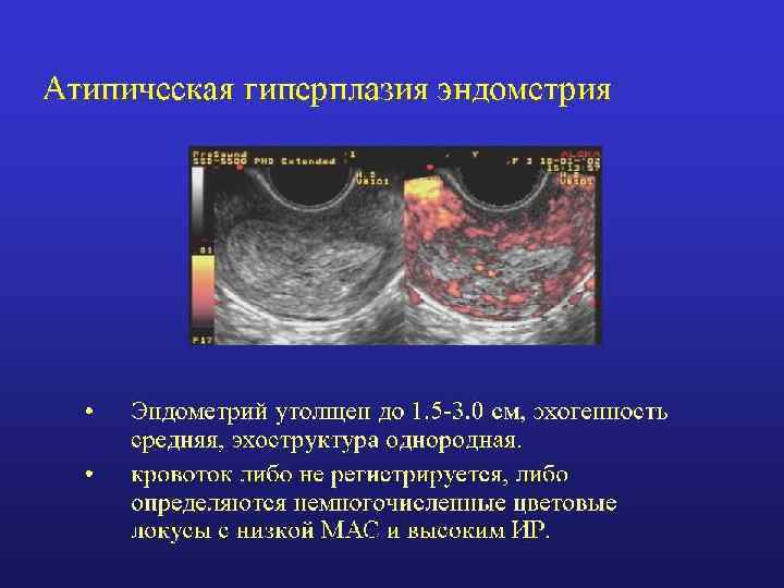 Виды гиперплазии эндометрия и их лечение