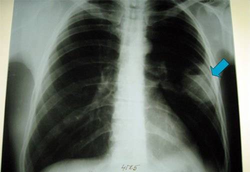 Левосторонняя пневмония (воспаление легких): нижнедолевая и верхнедолевая
