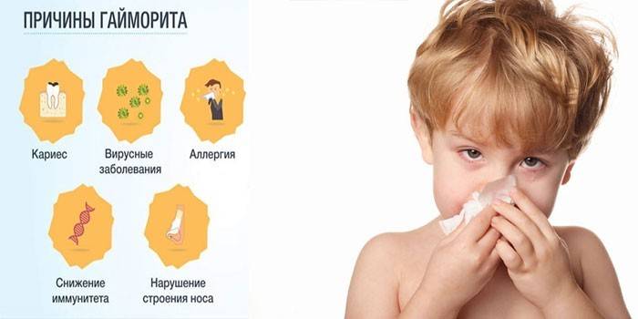 Симптомы и лечение гайморита у детей раннего и дошкольного возраста (2-7 лет)