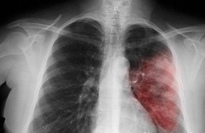 Верхнедолевая пневмония: виды, симптоматика, отличия от туберкулеза, лечение у детей и взрослых