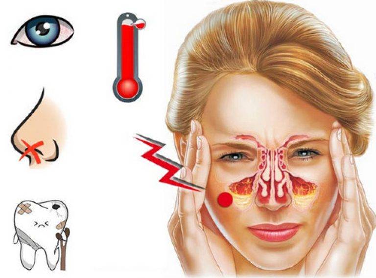 Фронтит - симптомы и лечение в домашних условиях у взрослых: капли в нос, как лечить