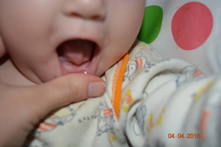 Сопли при прорезывании зубов у детей - как отличить от простуды?