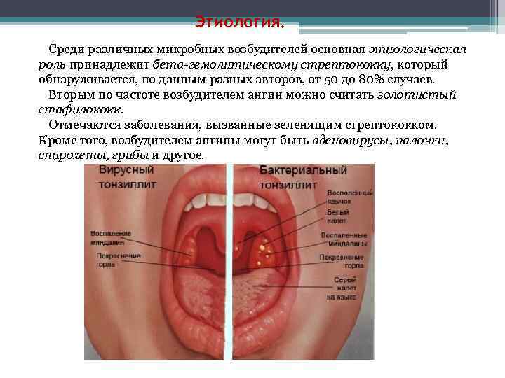 Бактериальная ангина - симптомы и лечение у детей и взрослых