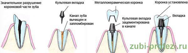 Депульпирование зуба: что это такое, показания и последствия. зачем и как депульпировать зубы