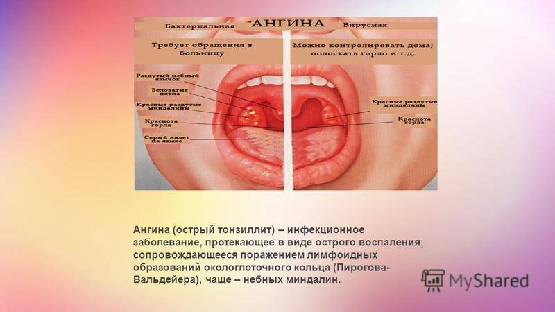 Гипертрофия нёбных миндалин | компетентно о здоровье на ilive