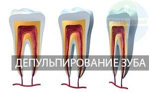 Депульпирование зуба перед протезированием: что это такое, нужно ли депульпировать под коронку