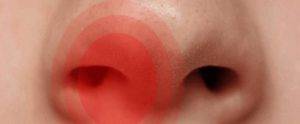 Почему постоянно появляются кровяные корочки и сохнет в носу: причины и лечение заболевания
