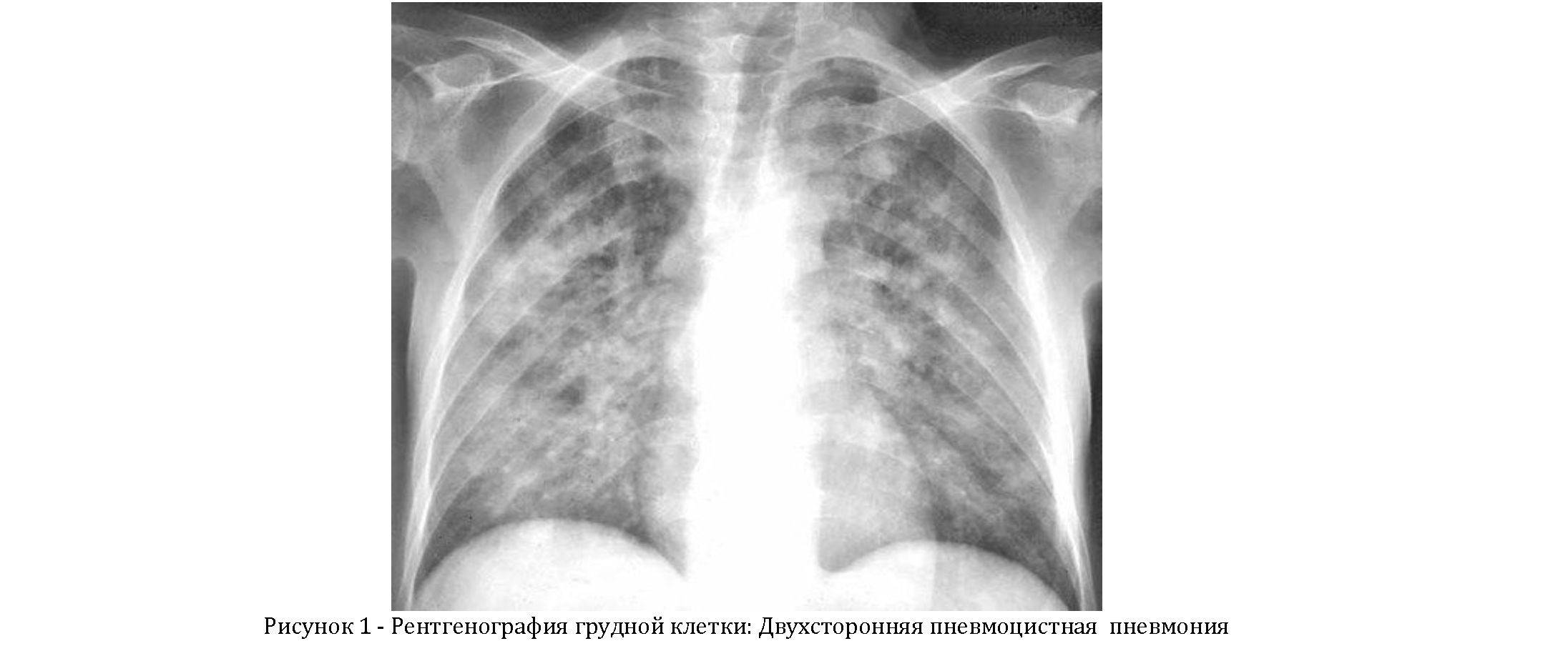 Симптомы пневмоцистной пневмонии. особенности лечения | pnevmonya.ru