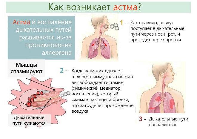 Бронхиальная астма — как начинается и первые признаки у взрослых
