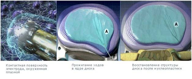 Нуклеопластика межпозвонковых дисков (холодноплазменная) – для удаления грыжи | s-voi.ru