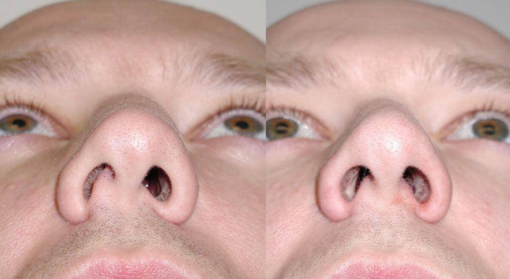 Кривая перегородка носа – последствия и симптомы искривления