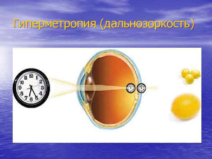 Гиперметропия средней степени у детей и взрослых - симптомы и лечение нарушения фокусировки зрения обоих глаз вблизи