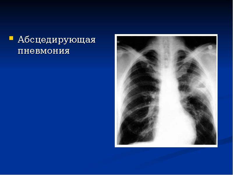 Абсцедирующая пневмония: причины, симптомы, лечение