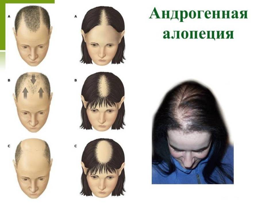 Андрогенная алопеция у женщин: лечение, признаки, симптомы, как можно остановить выпадение волос?