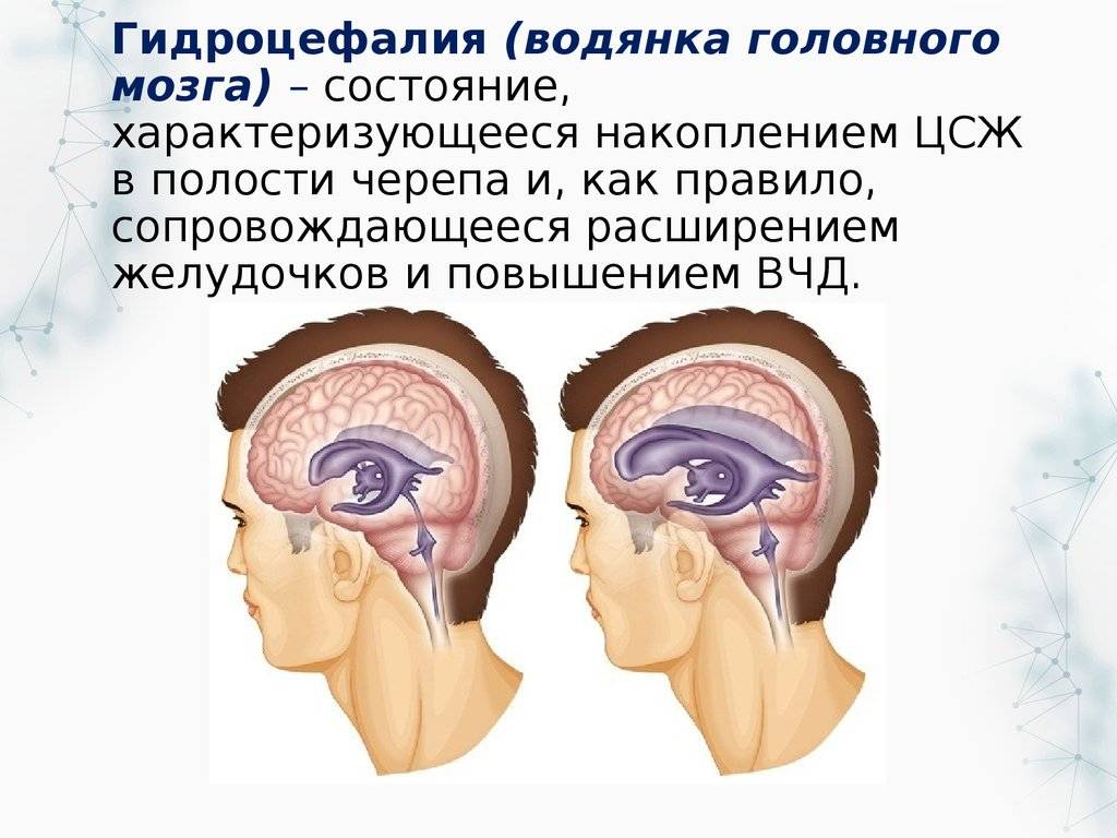 Умеренная наружная гидроцефалия головного мозга