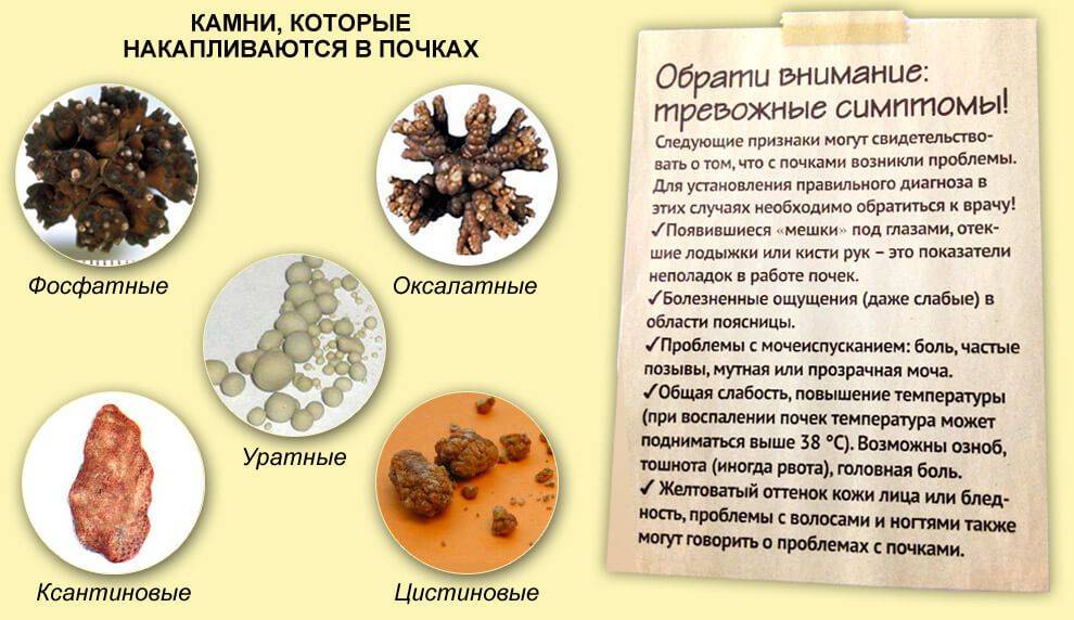 Лекарства от камней в почках - растворение и дробление | заболевания почек