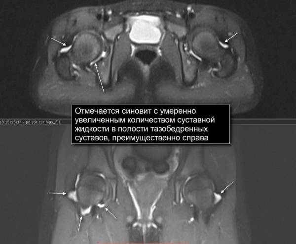 Синовит тазобедренного сустава : симптомы и лечение синовита тазобедренного сустава | компетентно о здоровье на ilive