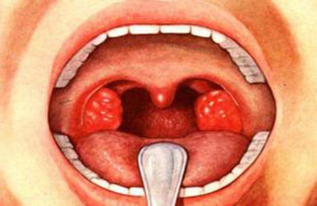 Симптомы назофарингита (ринофарингита) у взрослых и детей, формы заболевания и методы лечения — чтобы горло не болело