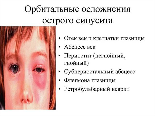 Синусит у ребенка: симптомы и лечение